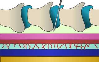 Эпидуральная анестезия при родах: плюсы и риски 2025