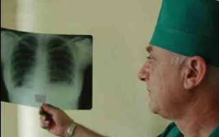 Симптомы и лечение туберкулёза почек в Москве