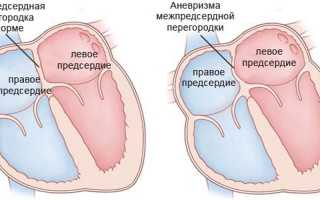Аневризма межпредсердной перегородки (МПП)