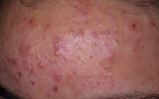 Как избавится от прыщей на лбу?