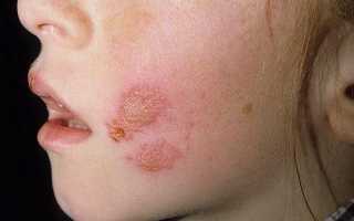 Герпес на теле: причины появления, симптомы, лечение