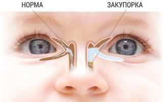 Непроходимость слезного канала у новорождённых: диагностика и лечение