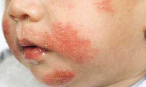 Потничка у новорожденных: причины, симптомы, эффективное лечение и профилактика