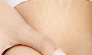 Растяжки во время беременности – из-за чего появляются и как их избежать