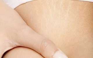 Растяжки во время беременности – из-за чего появляются и как их избежать