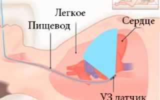 Чреспищеводная эхокардиография