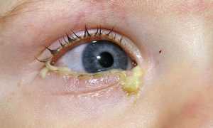Гноится глаз у новорожденного: причины, лечение, профилактика