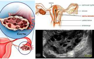 Поликистоз яичников и планирование беременности — возможно ли?