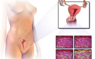 Эндометриоз матки — причины, симптомы и лечение