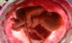 Гипоксия у новорожденных: причины, симптомы, лечение