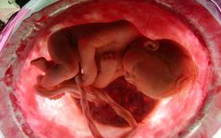 Гипоксия у новорожденных: причины, симптомы, лечение