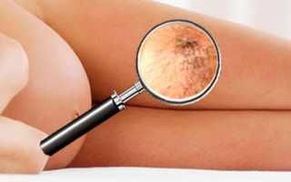 Варикоз при беременности – как справиться с проблемой