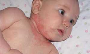 Атопический дерматит у детей – признаки, симптомы и лечение