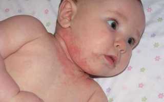 Атопический дерматит у детей – признаки, симптомы и лечение