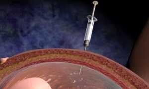 Анализ околоплодных вод при беременности: для чего нужен и кому