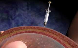 Анализ околоплодных вод при беременности: для чего нужен и кому