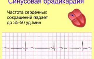 Синусовая брадикардия и ее лечение