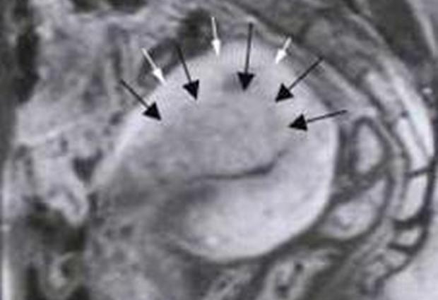 Гиперплазия аденомиоза: два пути развития