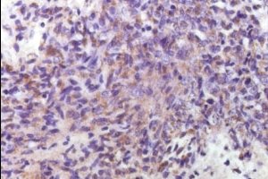 Лимфогранулематоз: причины, симптомы и лечение