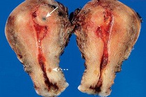 Гиперплазия аденомиоза: два пути развития