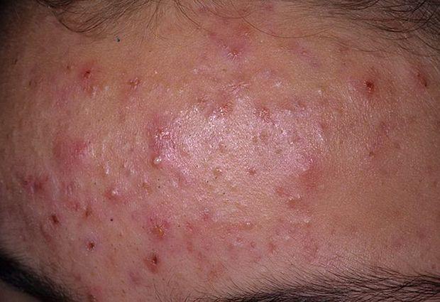 Как избавится от прыщей на лбу?