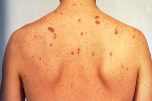 Саркома Капоши Саркома Капоши