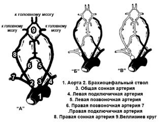 Атеросклероз брахиоцефальных артерий