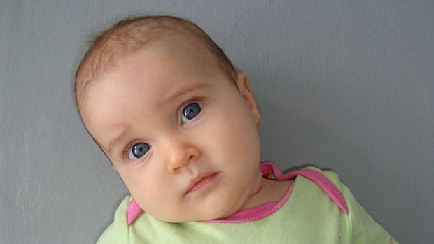 кривошея новорожденных