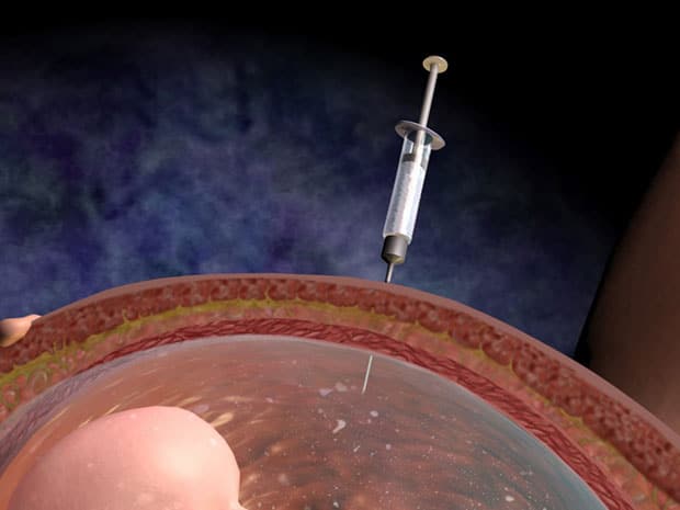 сроки анализа околоплодных вод