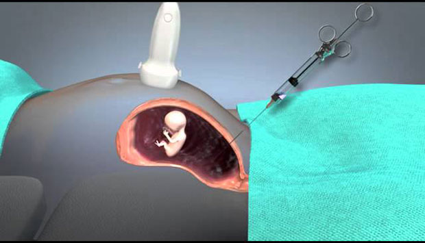 как правильно сдавать анализ околоплодных вод