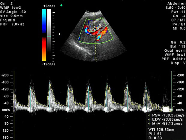 доплер расшифровка результатов