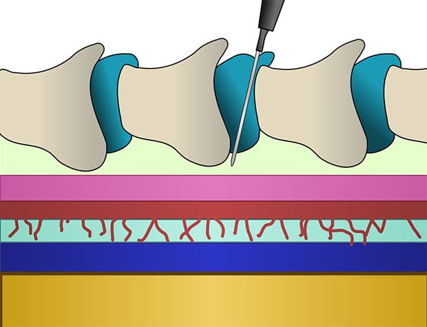 эпидуральная анестезия