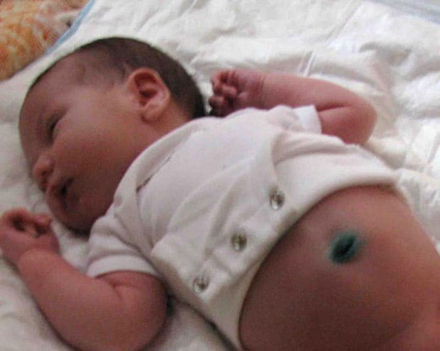 Газоотводная трубка у малыша