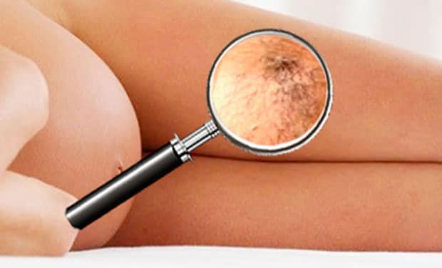 варикозное расширение вен при беременности