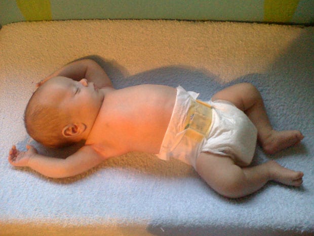 причины водянки у новорожденных